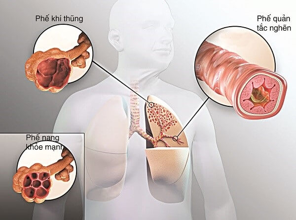 Đau sau lưng vùng phổi có ảnh hưởng gì đến sức khỏe?