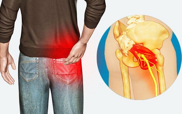 Hiện tượng đau cơ mông và cách làm thư giãn cơ