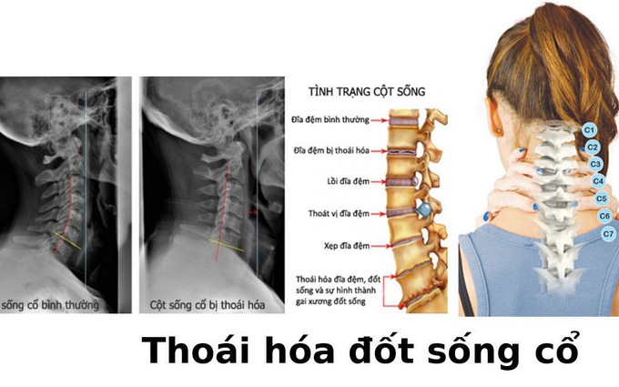 phuong-phap-massage-bam-huyet-tri-thoai-hoa-dot-song-co